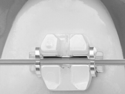 Коррекция прикуса