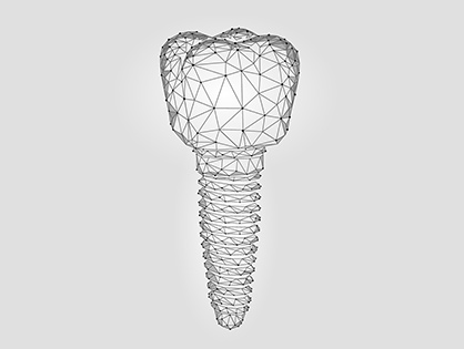 Имплантация зубов