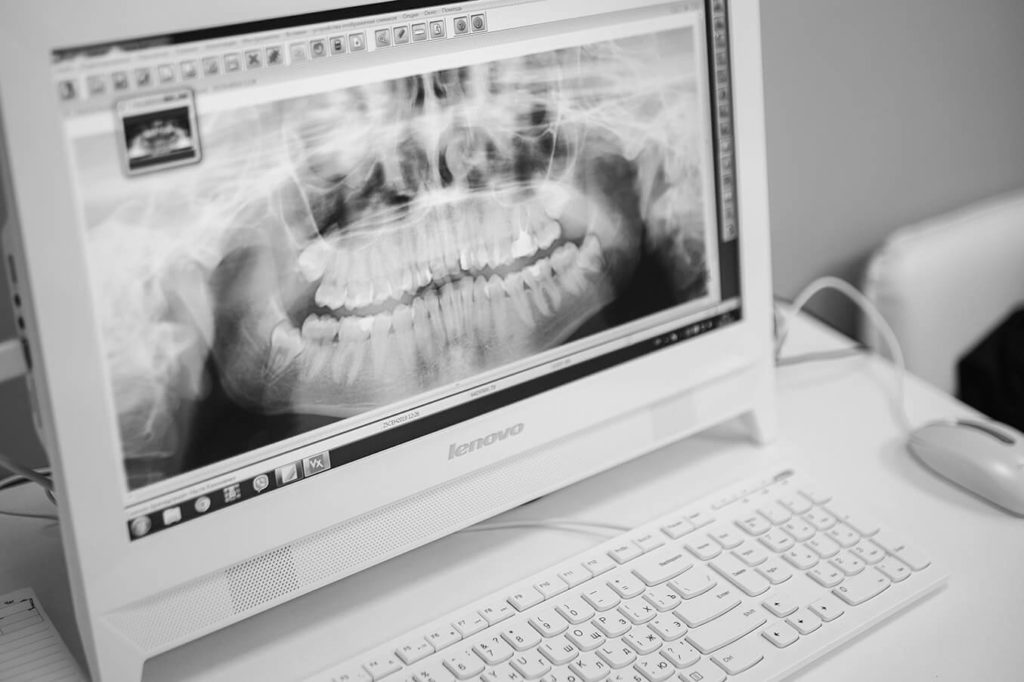 Ортопантомограма ᐉ Панорамний знімок зубів ᐉ Ортопантомограф у стоматології