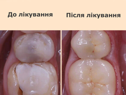 Встановлення керамічних накладок