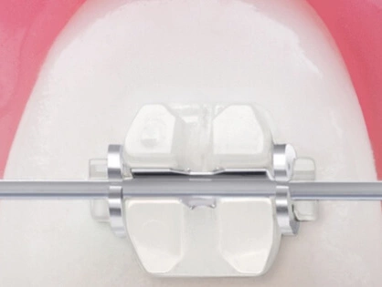 Сертифіковані брекет-системи