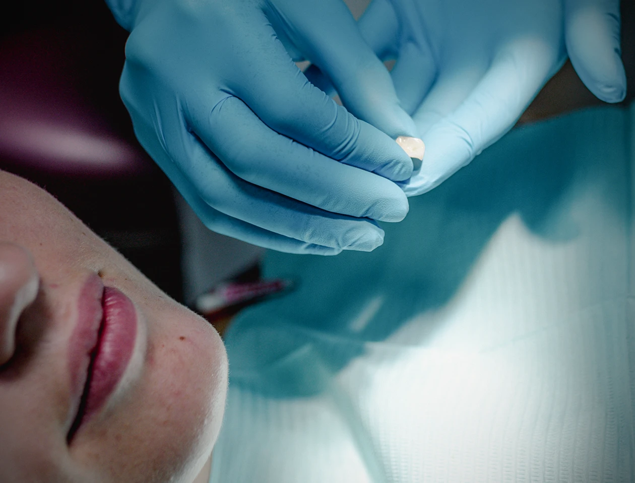 Естетична стоматологія. Встановлення вінірів та коронок