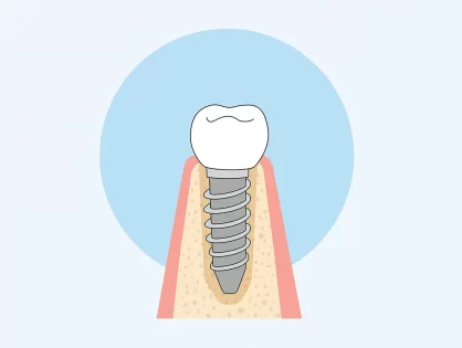 Розповсюджені питання при імплантації зубів
