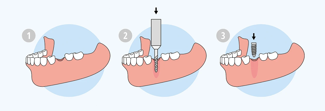 Дентальна імплантація Дентальна імплантація