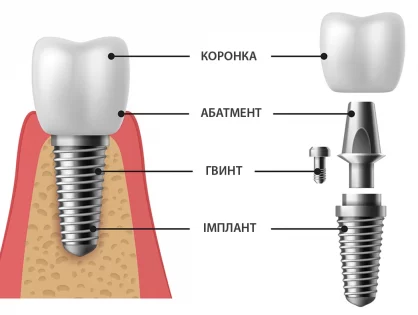 Що важливо знати при дентальній імплантації