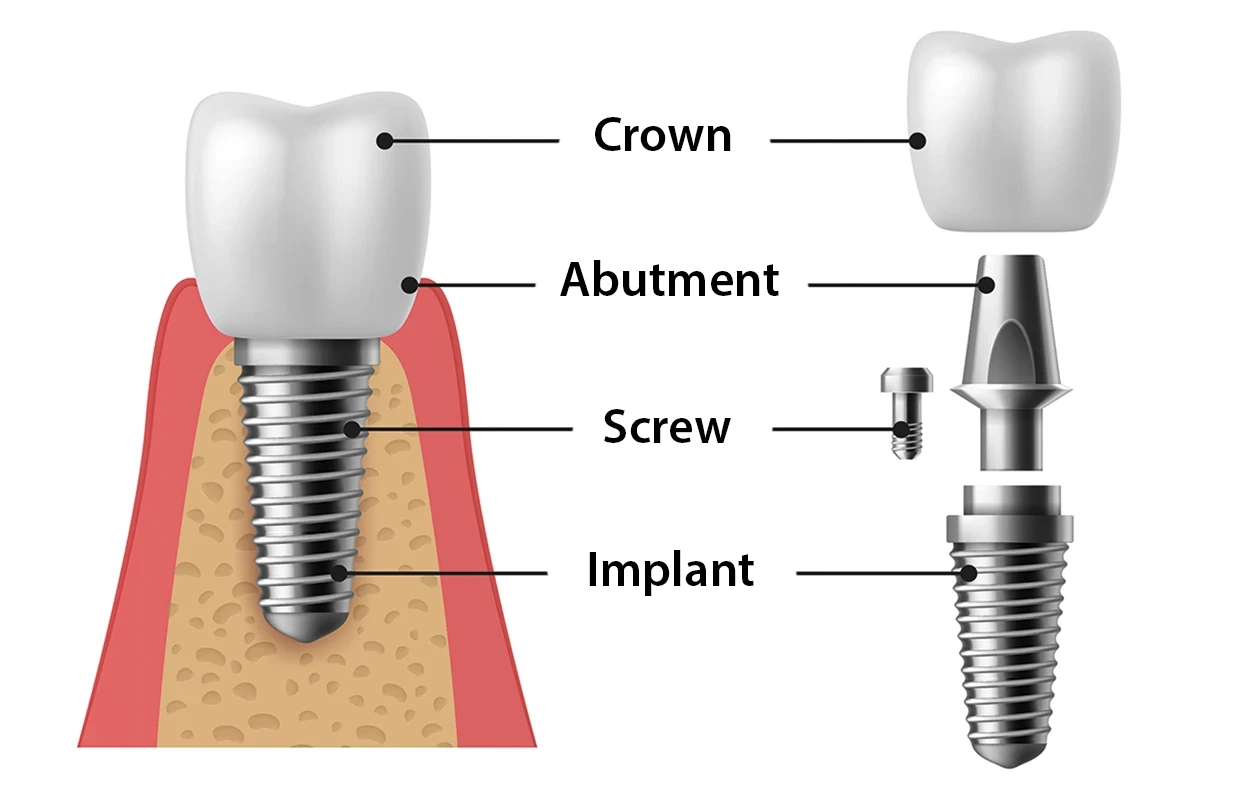 Everything to know about a dental implantation