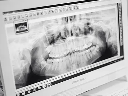 Лечение кариеса