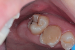 Реставрація зуба Реставрація зуба