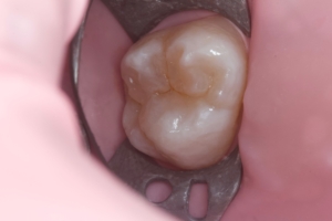 Реставрація зуба Реставрація зуба