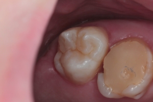 Реставрація зуба Реставрація зуба