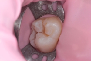 Реставрація зуба Реставрація зуба