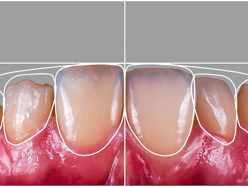 Цифровое моделирование улыбки