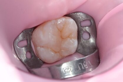 Реставрація зуба. До / після Реставрація зуба. До / після