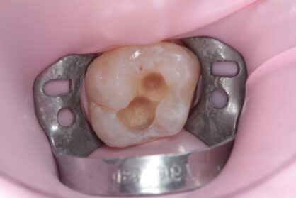 Реставрація зуба. До / після Реставрація зуба. До / після