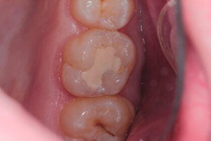 Реставрація зуба. До / після Реставрація зуба. До / після
