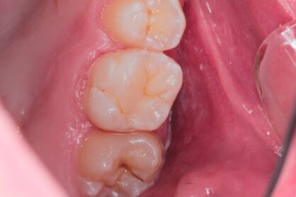 Реставрація зуба. До / після Реставрація зуба. До / після