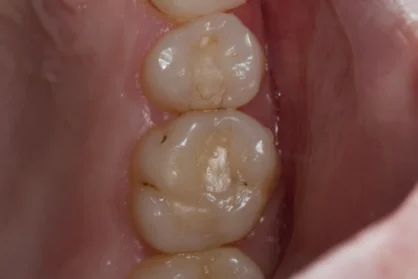 Реставрація зуба. До / після Реставрація зуба. До / після