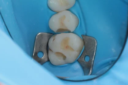 Реставрація зуба. До / після Реставрація зуба. До / після