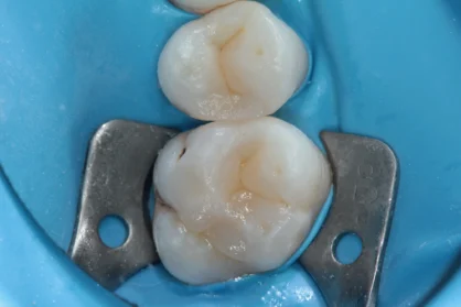 Реставрація зуба. До / після Реставрація зуба. До / після