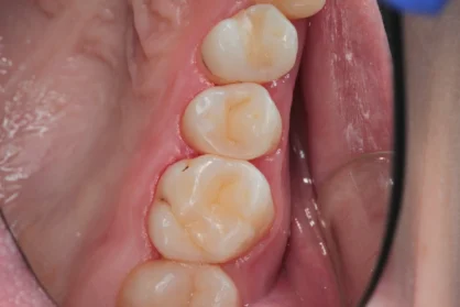 Реставрація зуба. До / після Реставрація зуба. До / після