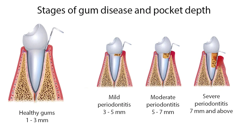 Стадії пародонтиту Стадії пародонтиту