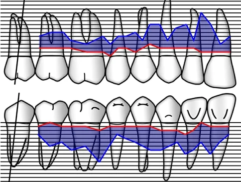 Лікування ясен